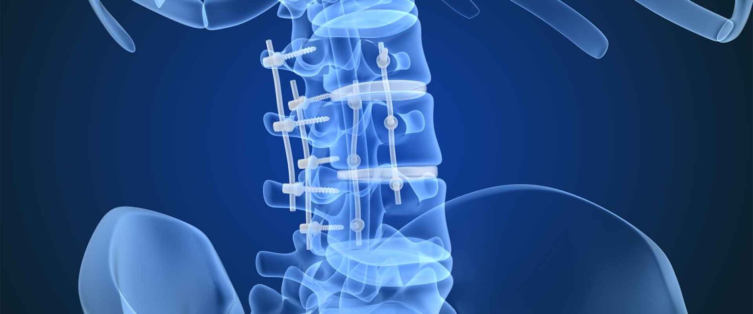 Alliance-spine New Product Launches Spine Implants Spinal Implants & PEEK Device Applications | Genesis Medical Plastics